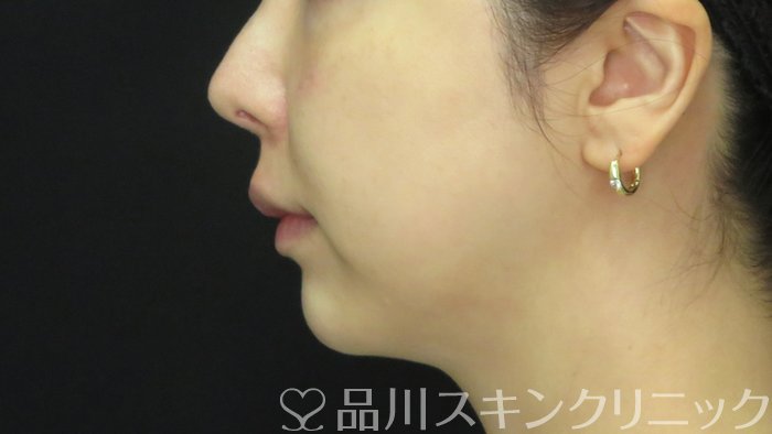 症例NO.71769のAFTER写真