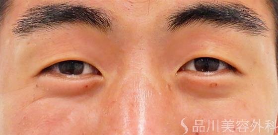 症例NO.52521のBEFORE写真