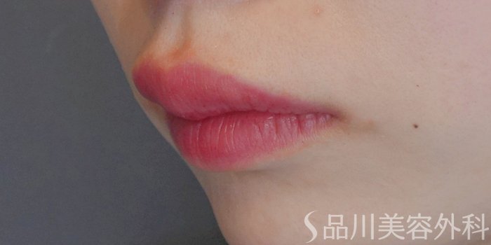 症例NO.72045のAFTER写真