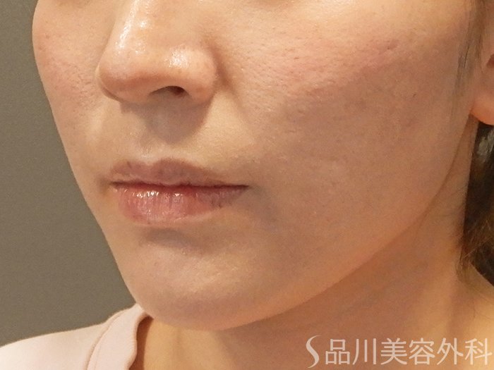 症例NO.69208のAFTER写真
