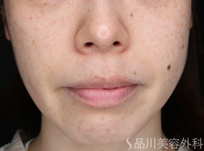 症例NO.73047のBEFORE写真