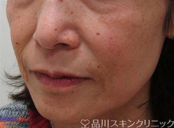 症例NO.30995のBEFORE写真