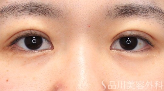 症例NO.62630のAFTER写真