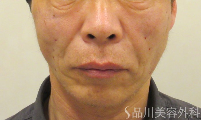 症例NO.73296のAFTER写真