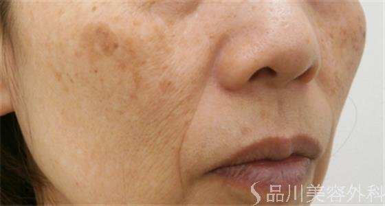 症例NO.20790のBEFORE写真