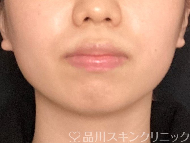 症例NO.65481のBEFORE写真