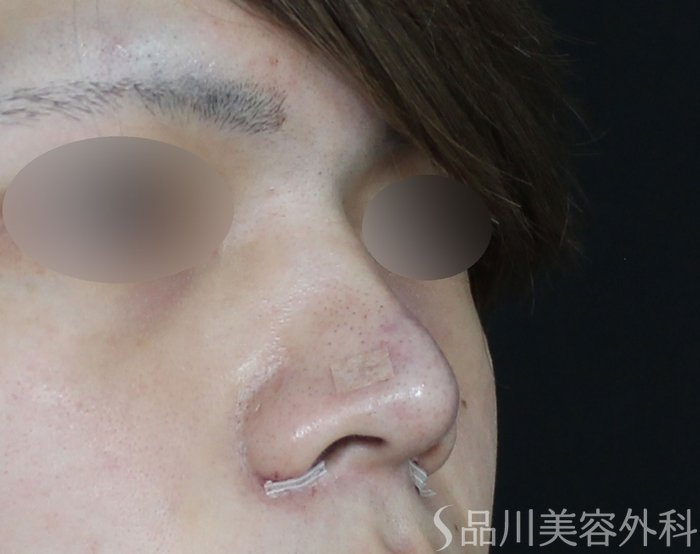 症例NO.71295のAFTER写真