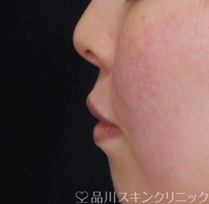 症例NO.66085のAFTER写真