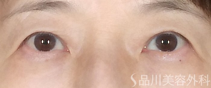 症例NO.70470のAFTER写真