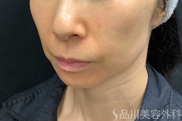 症例NO.69840のBEFORE写真