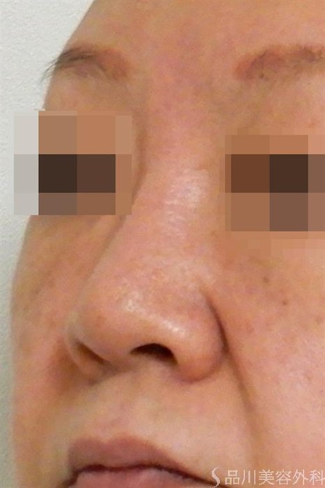 症例NO.42215のBEFORE写真