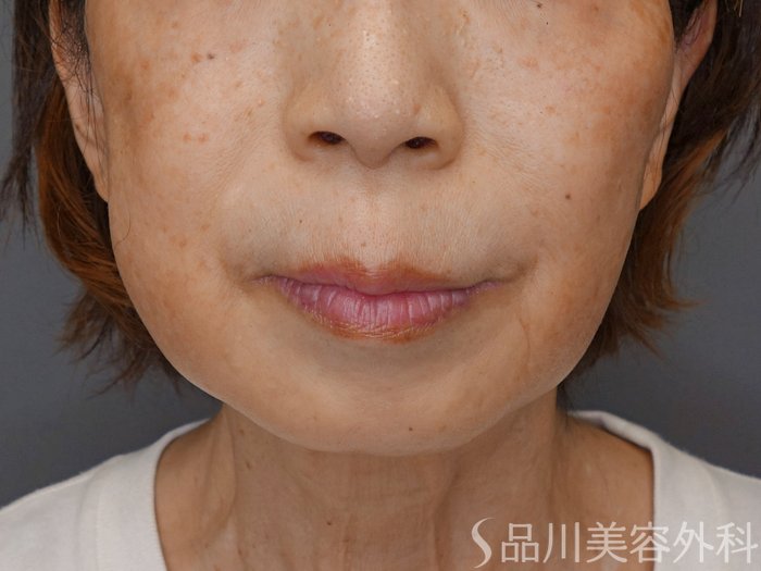症例NO.70939のBEFORE写真