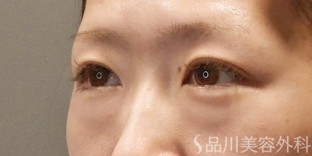 症例NO.74060のBEFORE写真