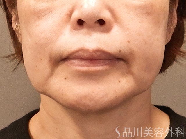 症例NO.72505のBEFORE写真