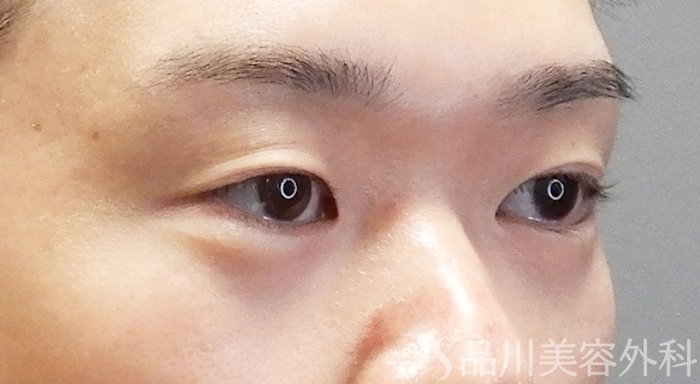 症例NO.71526のBEFORE写真