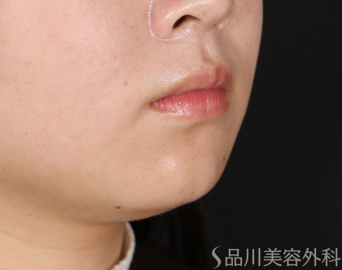 症例NO.72066のBEFORE写真