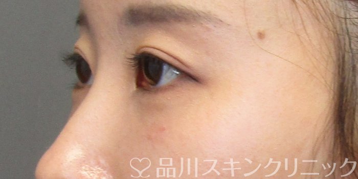 症例NO.75157のAFTER写真