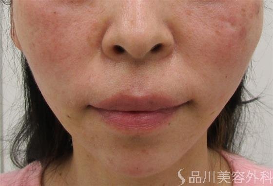 症例NO.43619のAFTER写真