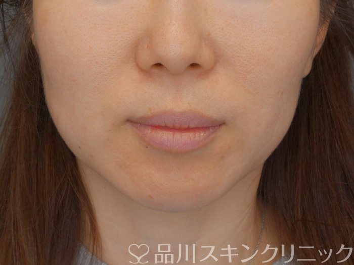 症例NO.72736のBEFORE写真