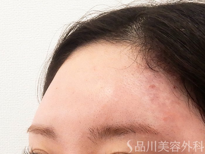 症例NO.62184のAFTER写真