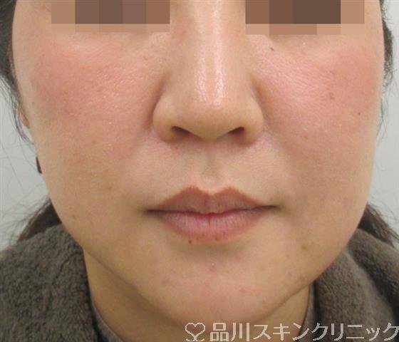 症例NO.27689のBEFORE写真
