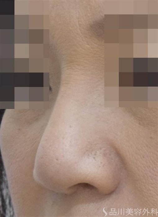 症例NO.48540のAFTER写真