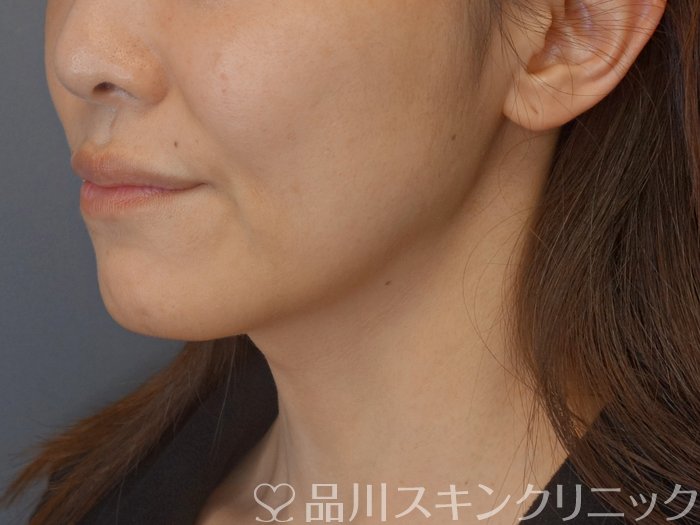 症例NO.72519のBEFORE写真