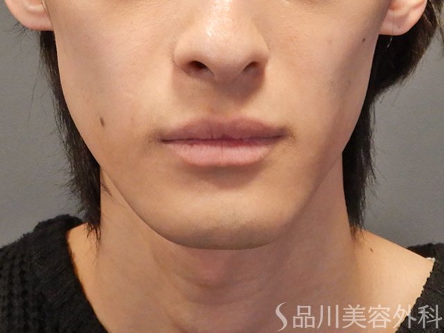 症例NO.73862のBEFORE写真