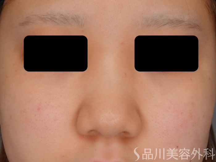 症例NO.74871のBEFORE写真