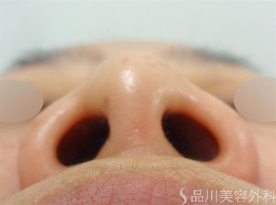 症例NO.27504のBEFORE写真