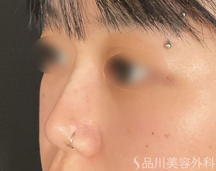 症例NO.75191のAFTER写真