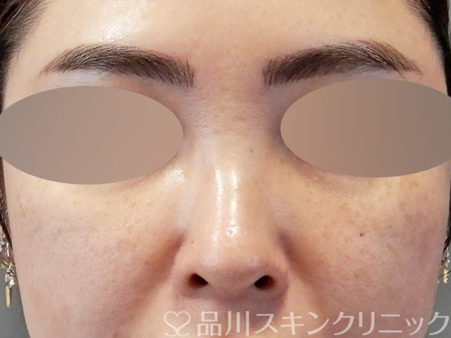 症例NO.67609のBEFORE写真