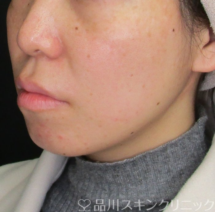 症例NO.73288のAFTER写真