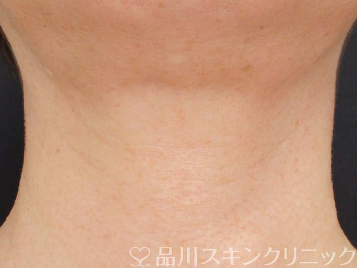 症例NO.74584のAFTER写真