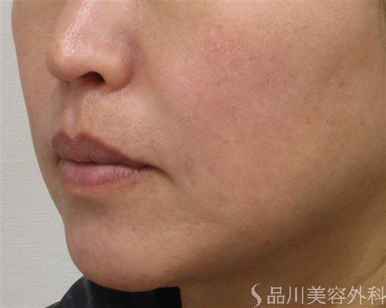 症例NO.45192のAFTER写真