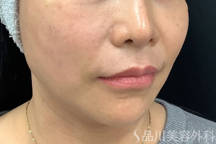 症例NO.73318のAFTER写真