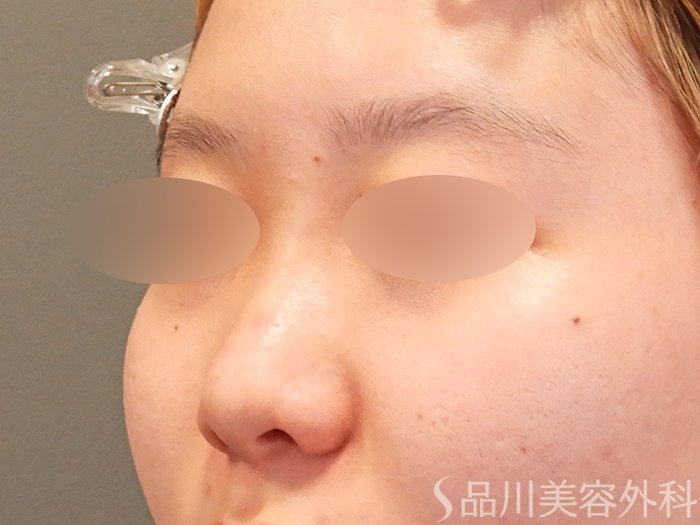 症例NO.70150のBEFORE写真