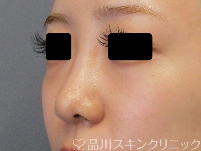 症例NO.74691のBEFORE写真