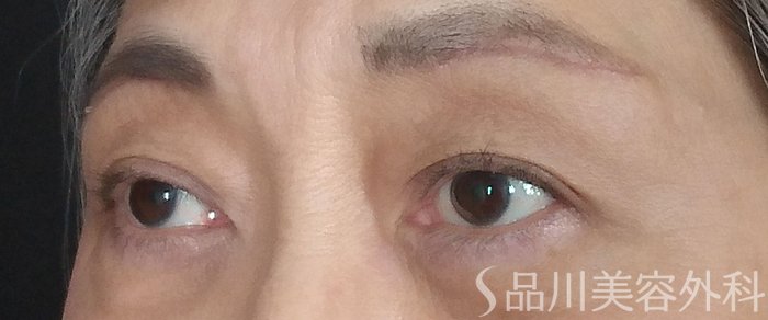症例NO.71564のAFTER写真