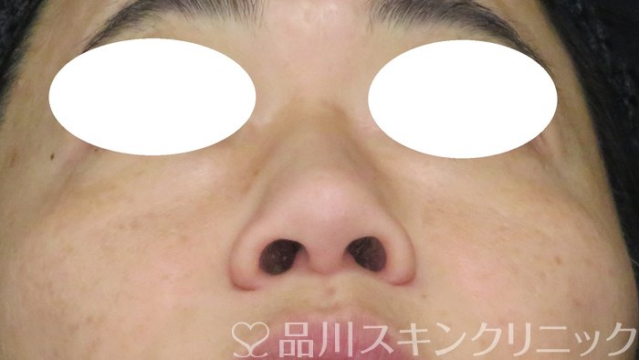 症例NO.70192のBEFORE写真