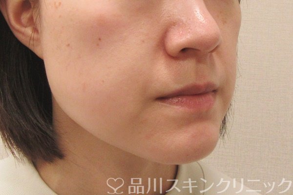 症例NO.69276のBEFORE写真