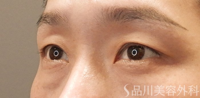 症例NO.71337のBEFORE写真