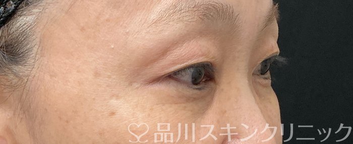 症例NO.74652のBEFORE写真