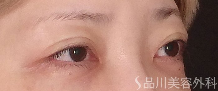 症例NO.70574のAFTER写真