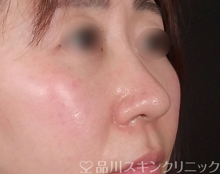 症例NO.69219のAFTER写真