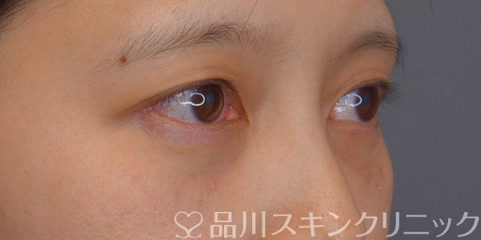 症例NO.73069のAFTER写真