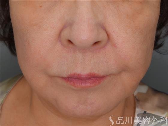 症例NO.52973のBEFORE写真