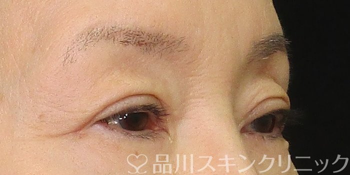 症例NO.69791のAFTER写真