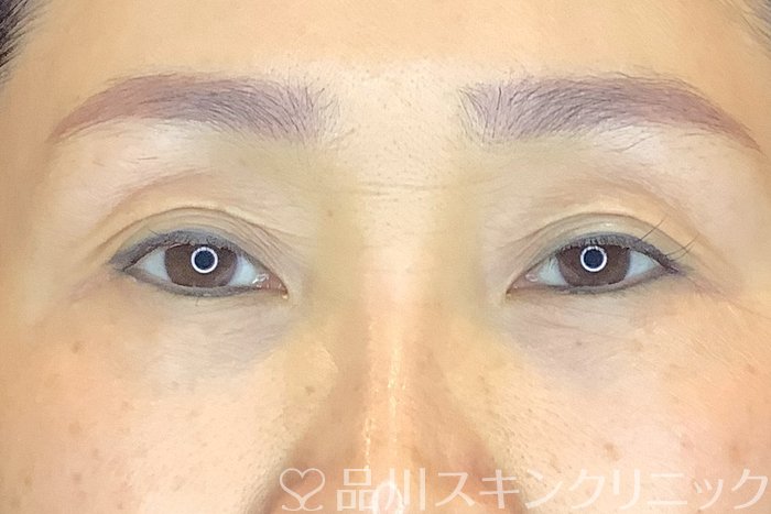 症例NO.65634のAFTER写真