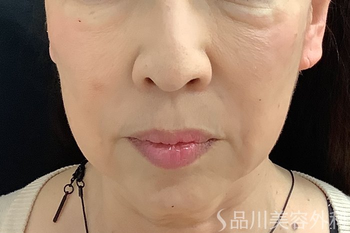 症例NO.71244のAFTER写真
